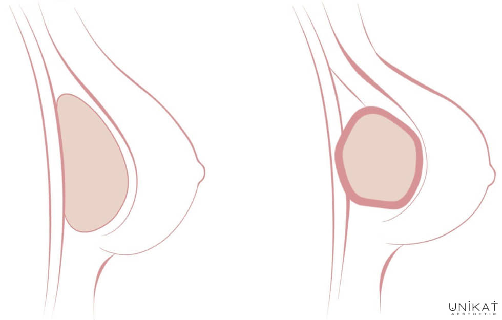 Intaktes Brustimplantat und komprimiertes Brustimplantat durch Kapselfibrose