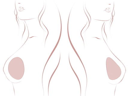 Unterschiedliche Formen der Brust bei runden und anatomischen Brustimplantaten