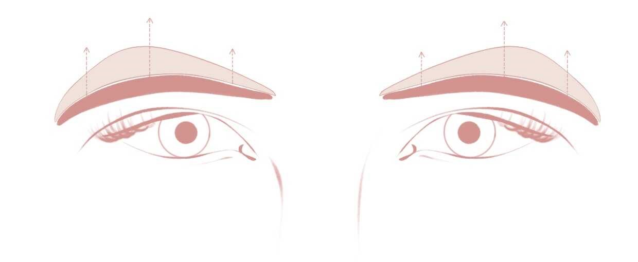 Operative Entfernung eines dünnen Hautstreifens zur dauerhaften Anhebung der Augenbrauen.