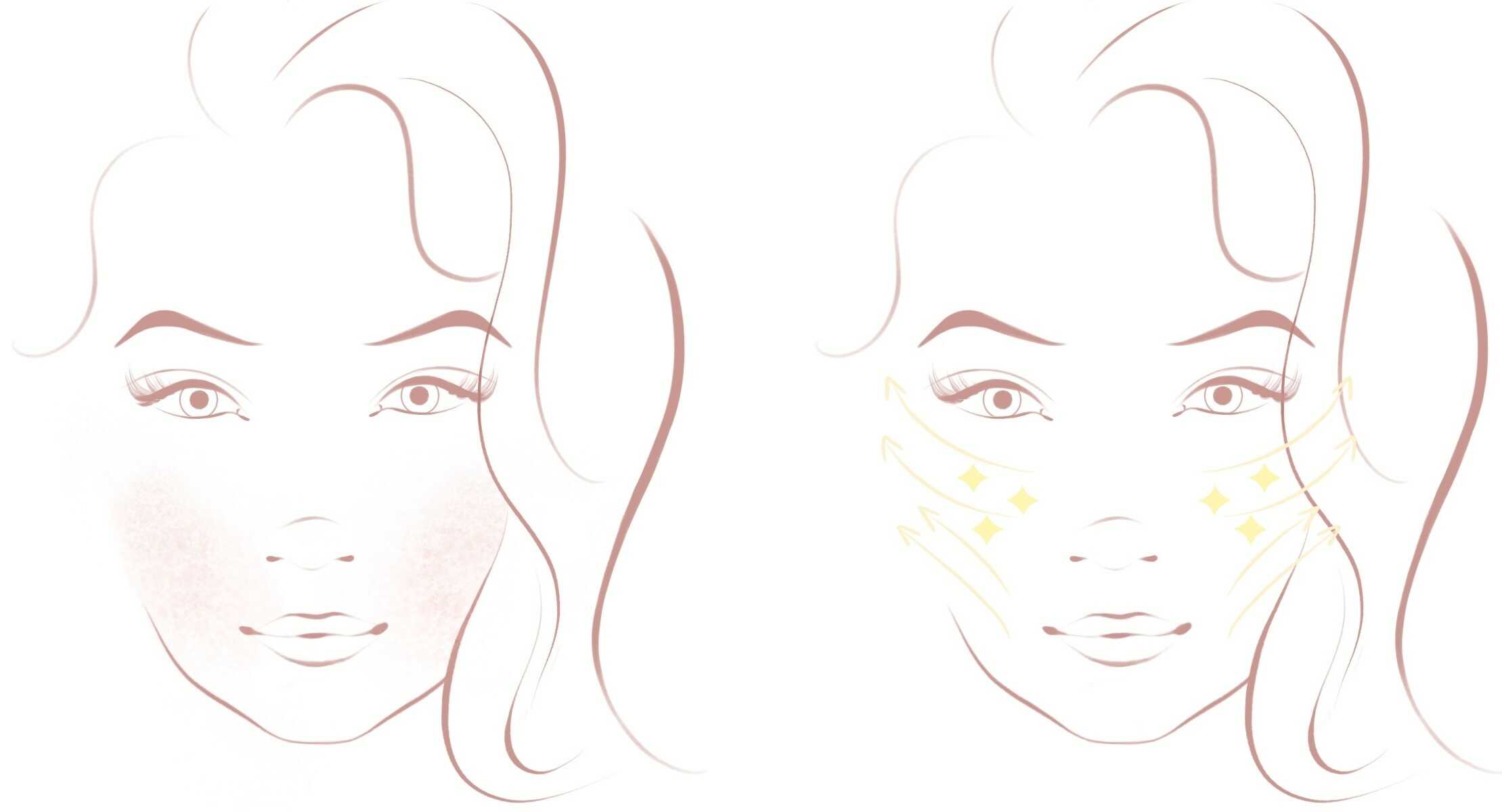 Vorher und Nachher des Gesichts nach einer Wangenunterspritzung