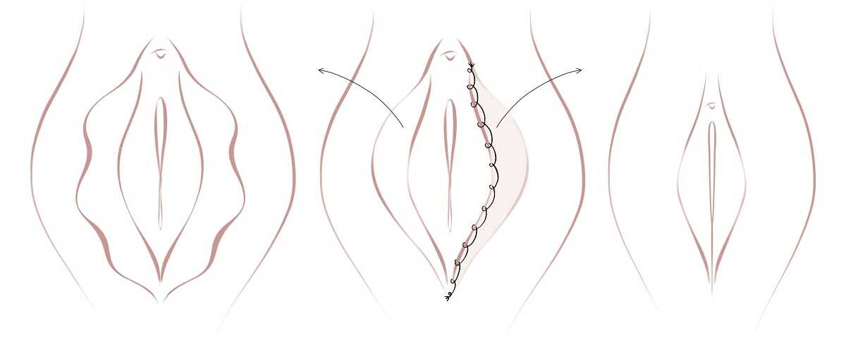 Skizze zur Verkleinerung der Schamlippen in der Intimchirurgie